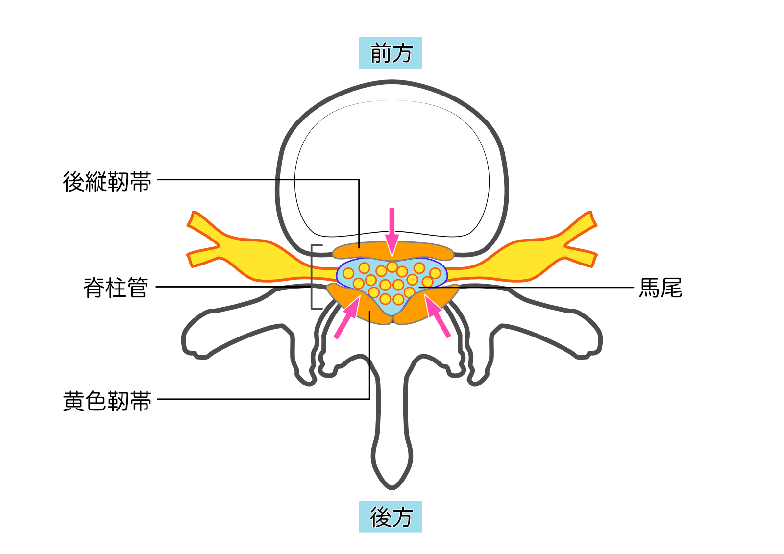 脊柱管狭窄症　馬尾型